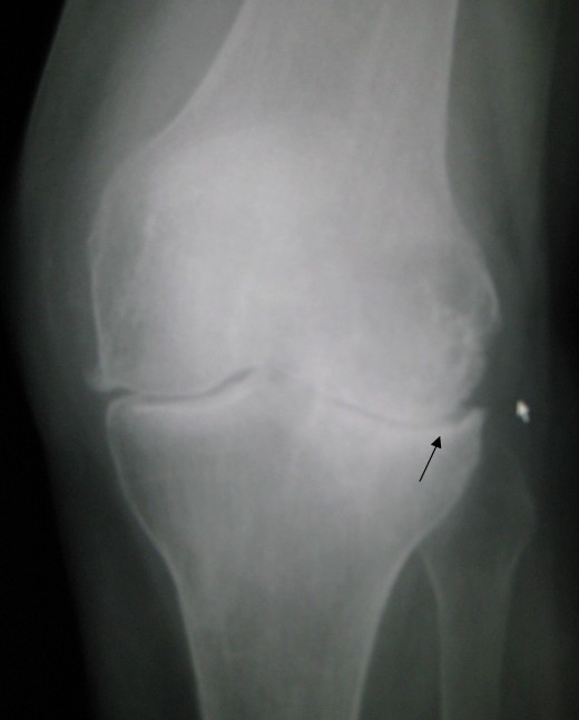 Osteoarthritis of the knee. The space between the bones is narrowed and other changes of arthritis are present.
