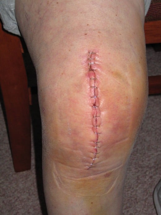 A longer, vertical incision is made over the joint for total knee replacement.