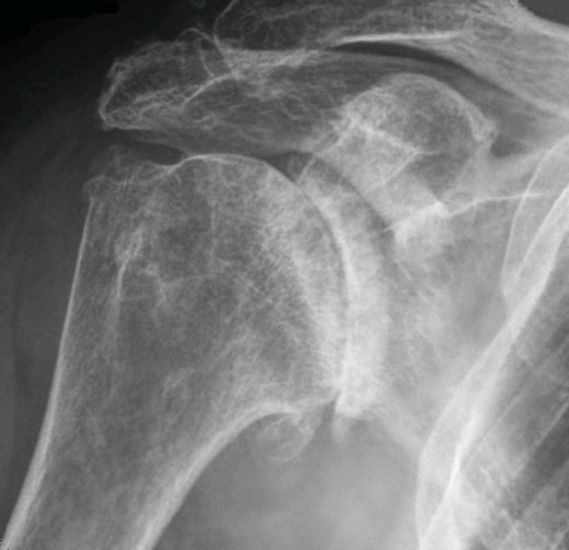Osteoarthritis of the right shoulder.