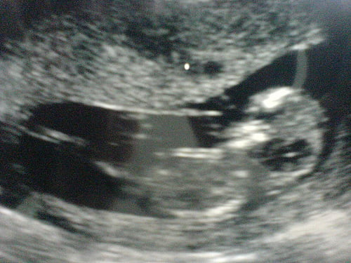 12 week baby scan 
