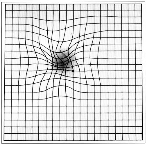 Distortion such as this when viewing an Amsler Grid indicates that more exhaustive visual field testing is necessary.