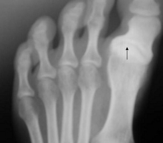 The arrow points to osteoarthritis in the toe joint.