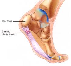 PLANTAR FASCIITIS
