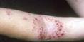 Eczema on Arm