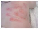 Eczema