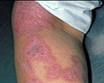 Eczema