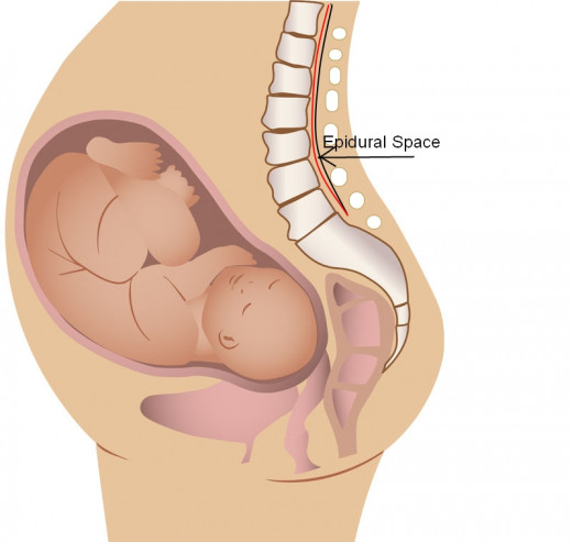 The Epidural Space is where the Epidural Catheter is placed which will pump analgesia through it to numb the nerves of the Uterus and Pelvis. The Red line is representative of the Spinal Cord.