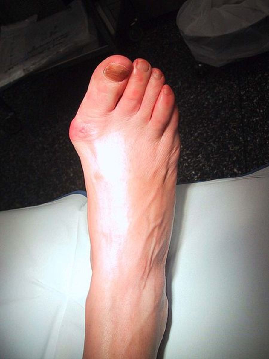 The Way to Treat Bunions