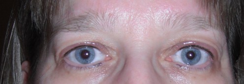 Day of procedure. Upper eyelids are swollen and liner is darker and thicker then end results. 