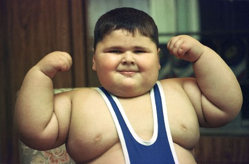 Childhood Obesity Greatly Increases the risk of Psoriasis and Psoriatic Arthritis.