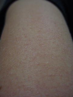 On the arm