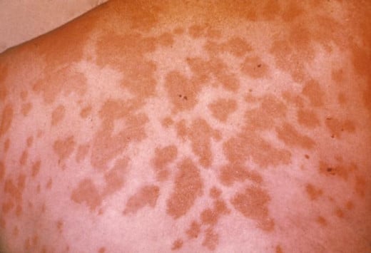 As valley fever advances, patients may notice skin lesions like these on their upper bodies, arms, or legs. On rare occasions, these lesions may appear on other body parts.