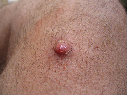 Basal cell skin cancer before removal