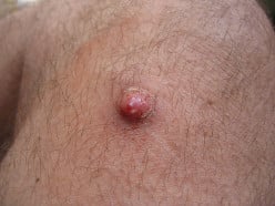 Skin cancer:What it is,What to do about it?