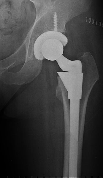 A hip replacement can be a new lease of life for someone who is in constant pain