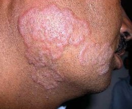 Nasty Infectious Diseases You Want To Avoid - Ringworm