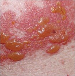 Nasty Infectious Diseases You Want To Avoid - Shingles