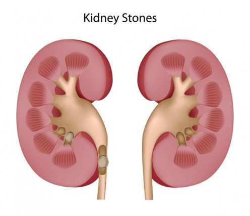 Kidney Stone