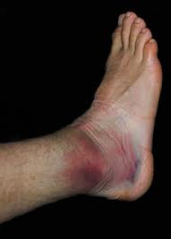 Secrets To Avoid or Rehabilitate Ankle Injuries In Gymnastics