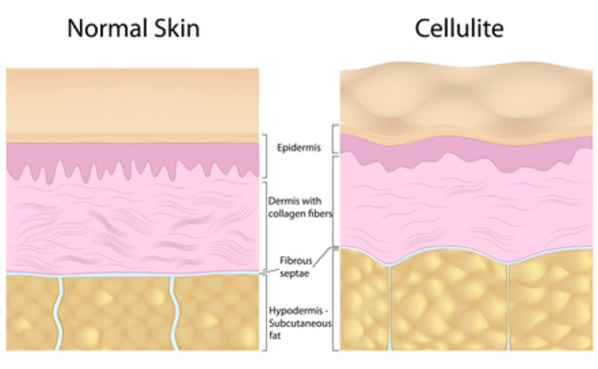 How to Decrease the Visibility of Cellulite | Bellatory