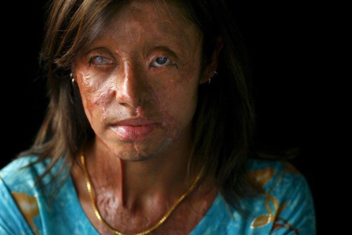 Image result for women acid"