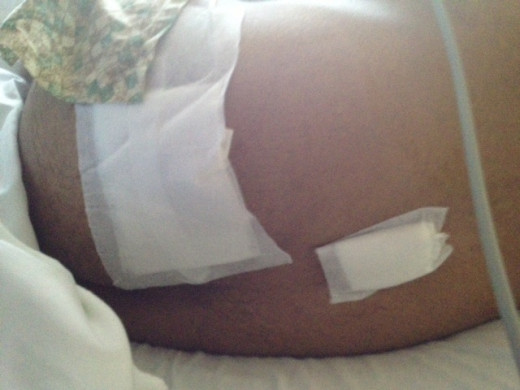 Photo of my hip and lower back after surgery