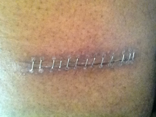Photo of the incision where they removed the pump after about 2 weeks.