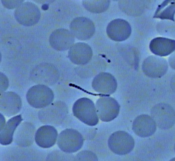 Spirochete in my blood seen through Dark Field Microscopy
