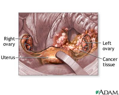 Ovarian canceer