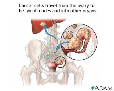 Cancer cells travel from the ovary to the lymph nodes and into other organs.