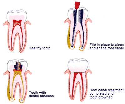 Root Canal Procedure