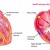 Normal heart vs WPW heart