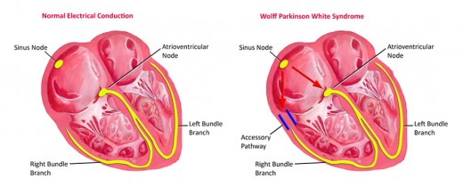 Normal heart vs WPW heart