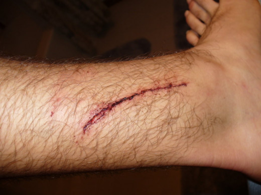 An open wound or laceration on the leg