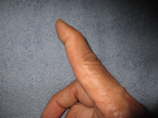 The classic "swan-neck" deformation of the index finger pictured.