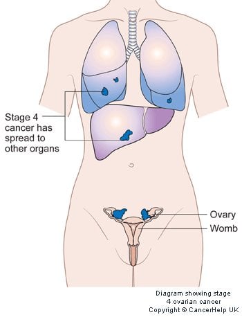 survival rates for stage 4 ovarian cancer will depend on whether other organs have been affected.