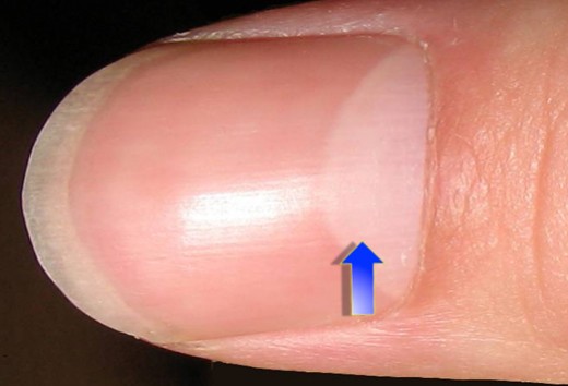 The goal: a healthy nail!