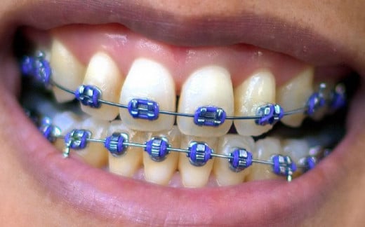 The time leading up to getting braces can be one of apprehension and anxiety--here's how to prepare for getting braces. 