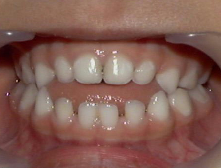 An open bite, which can be one way to tell that you need braces, can cause health problems such as TMJ or sleep apnea. 