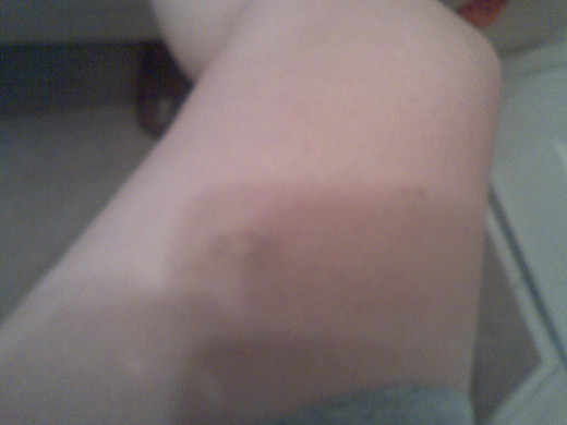 My leg after being kicked while on the ground.
