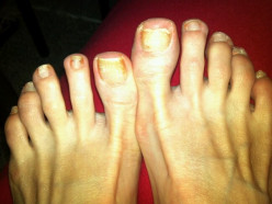 Tea Tree Oil on Toenail Fungus: Photos That Let You Decide If It Works