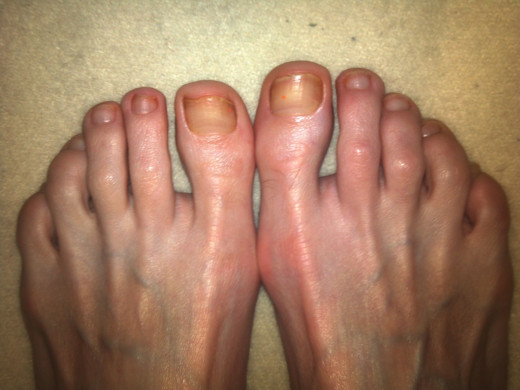 I left the tiny trace of polish on the right big toe in order to track toenail growth.