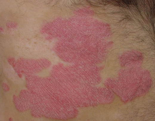 A typical psoriasis plaque
