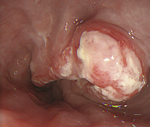 Tumor in the esophagus