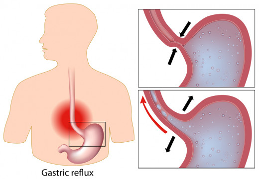 Indigestion, GERD, and Barrett's esophagus can be early warning signs.