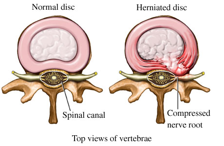 http://denverchiropractor.com/blog/herniated-disc-same-as-bulging-disc/