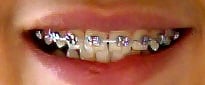 Braces can help you achieve the best smile possible. 