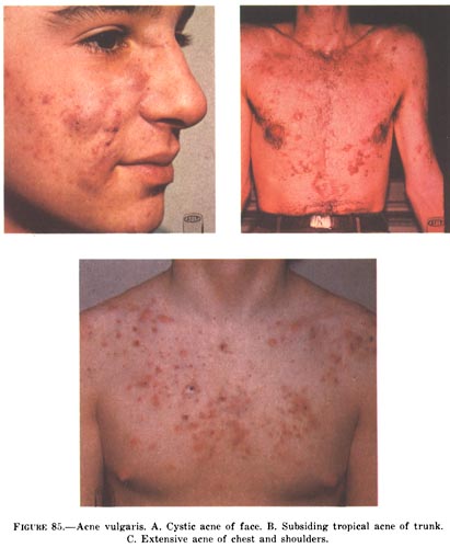 Severe acne on chest.
