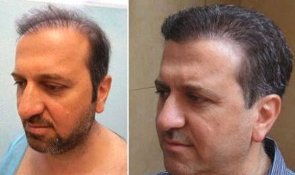 Hair transplantation takes at least 6 months to show this type of improvement.
