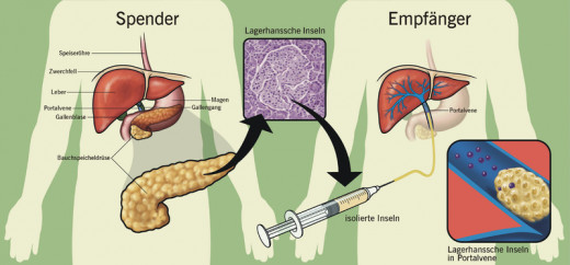 Pancreatic Diabetes Implant Treatment: What Happens When Your Pancreas ...